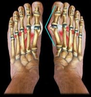 varus deformity foot